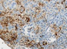 Inflamed tumor express PD-L1 PD-L1 Expression in HNC PD-L1
