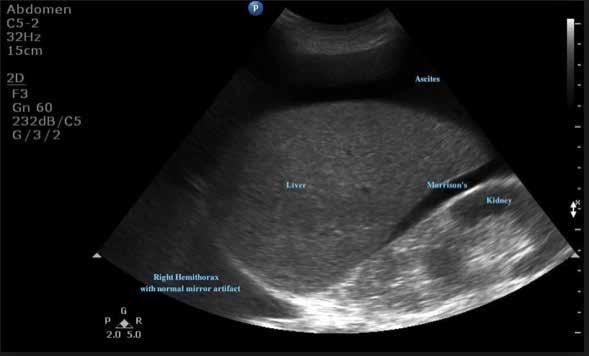 Right Upper Quadrant Ultrasound No focal intrahepatic lesions Normal