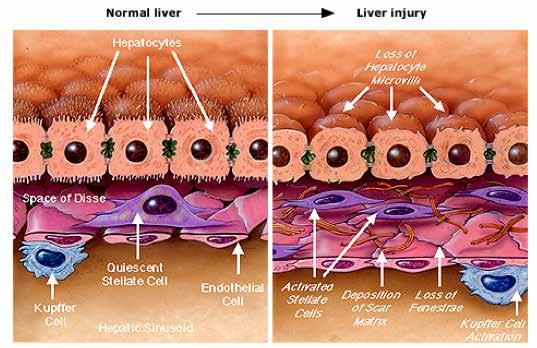 How do activated lipocytes cause portal