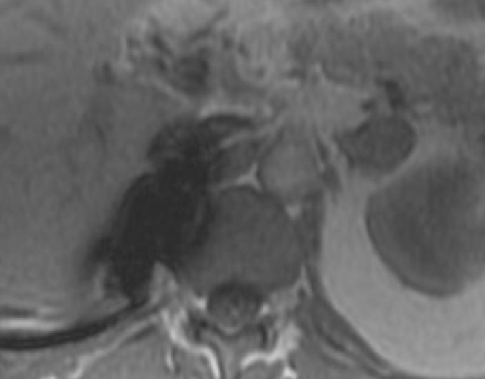 Pitfall: CSI MRI Lipid containing metastasis from clear cell renal cell carcinoma (RCC)