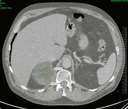 7 Radiological evaluation The two primary predictors of malignancy within an adrenal incidentaloma are the size of the mass and imaging characteristics on computed tomography (CT; Figures 2, 3) or