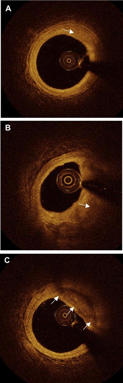 JACC: CARDIOVASCULAR INTERVENTIONS, VOL. 4, NO. 12, 2011 1261 Figure 3. In Vivo Plaque Characterization (A) Fibrous plaque. Homogeneous high-intensity signal (arrow). (B) Lipidladen plaque.