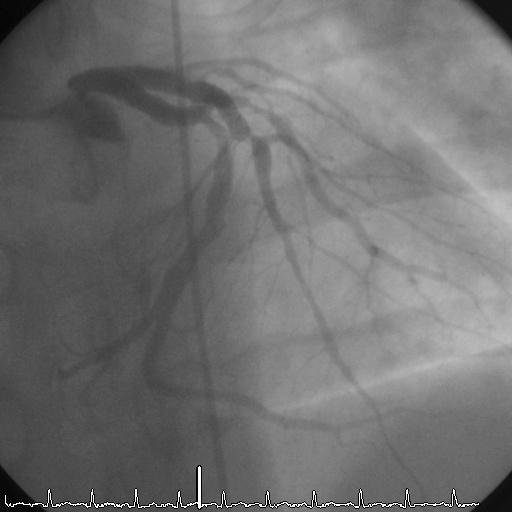 Stent Strut Vessel Wall Interaction Case report: 34 YO white man with an acute coronary syndrome in