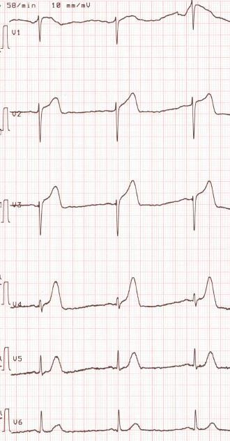 B.Z., 07.02.1941 20 months later. Onset of typical chest pain at 09:15 AM on April 2, 2010.