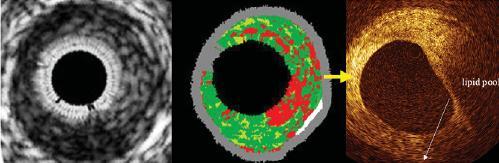 OCT/IVUS VH TCFA Detection Algorithm Plaque thickness >600 µm, >3 frames Comfortable IBIS 4 AIT AIT No Yes Courtesy: Hector Garcia Confluent NC NC >10% >10% (VH) No >15% >15% FF FF (VH) Yes Fibrous