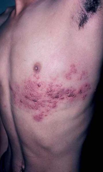 25 Clinical Correlation: Herpes Zoster Virus Shingles