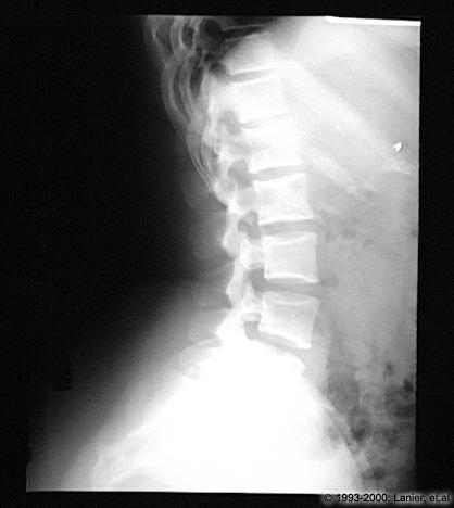 Radiologic Anatomy Correlation A. Identify B. Which spinal nerve exits here? Lateral L-spine Spinal Nerves (two pairs shown) 1.