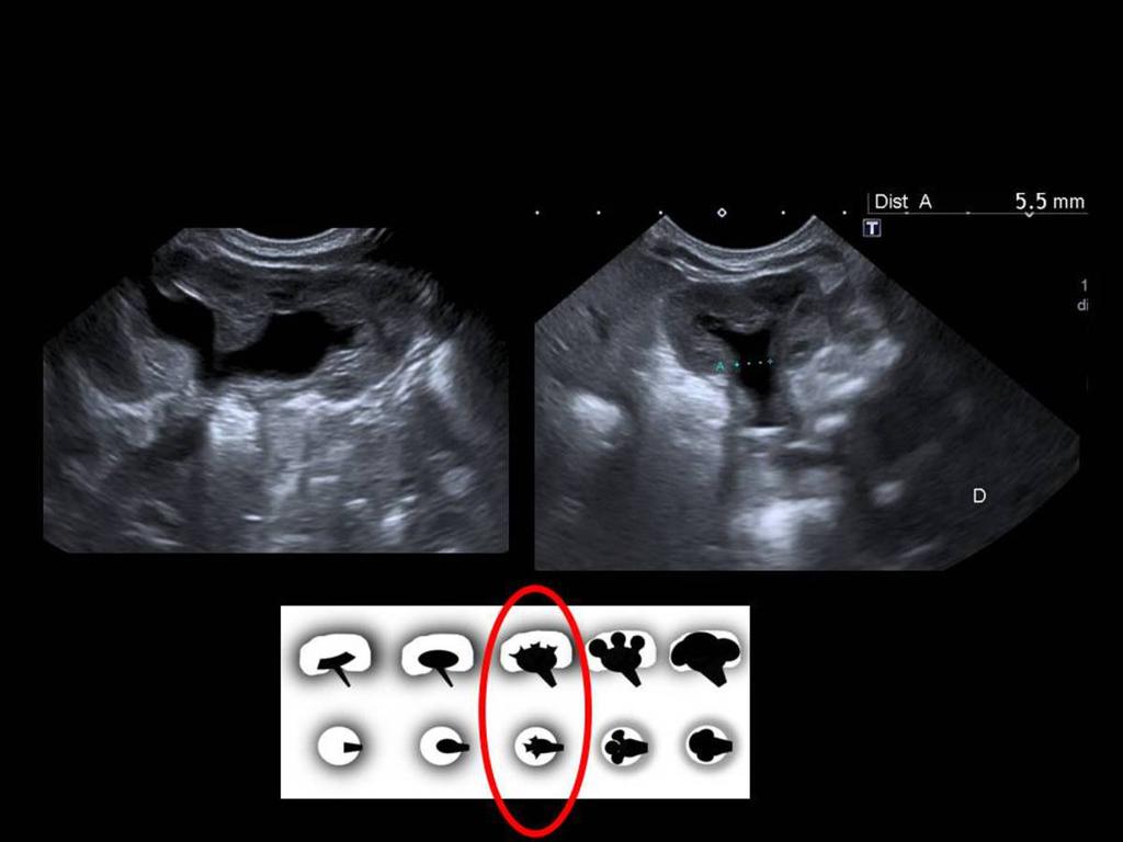 Fig. 7: Figure 7. Grade II HN in a 7-day-old newborn.