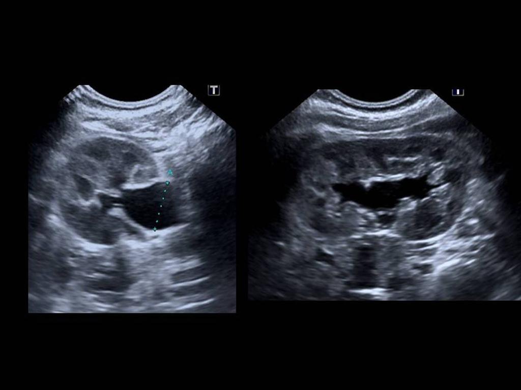 Fig. 8: Figure 8. Grade I HN in a 7-day-old newborn.