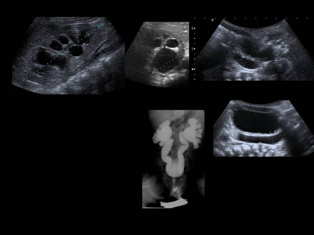 Fig. 11: Figure 11. 1-day-old boy. Bilateral severe CHN on fetal US. The US scan showed grade III bilateral HN.