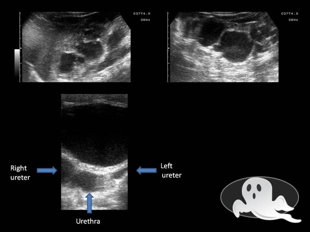 Fig. 17: Figure 17. PUV Newborn with gross dilatation of both kidneys.
