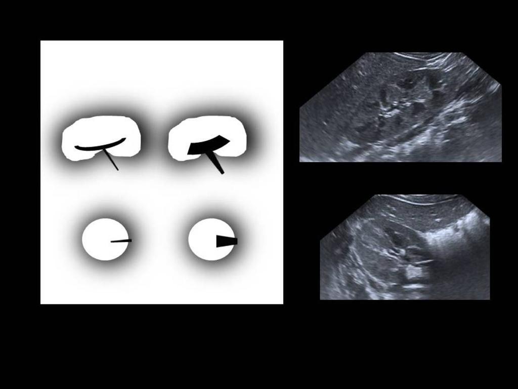 Fig. 1: Figure 1. Classification of the Society for Fetal Urology for CHN. Fig. 2: Figure 2.