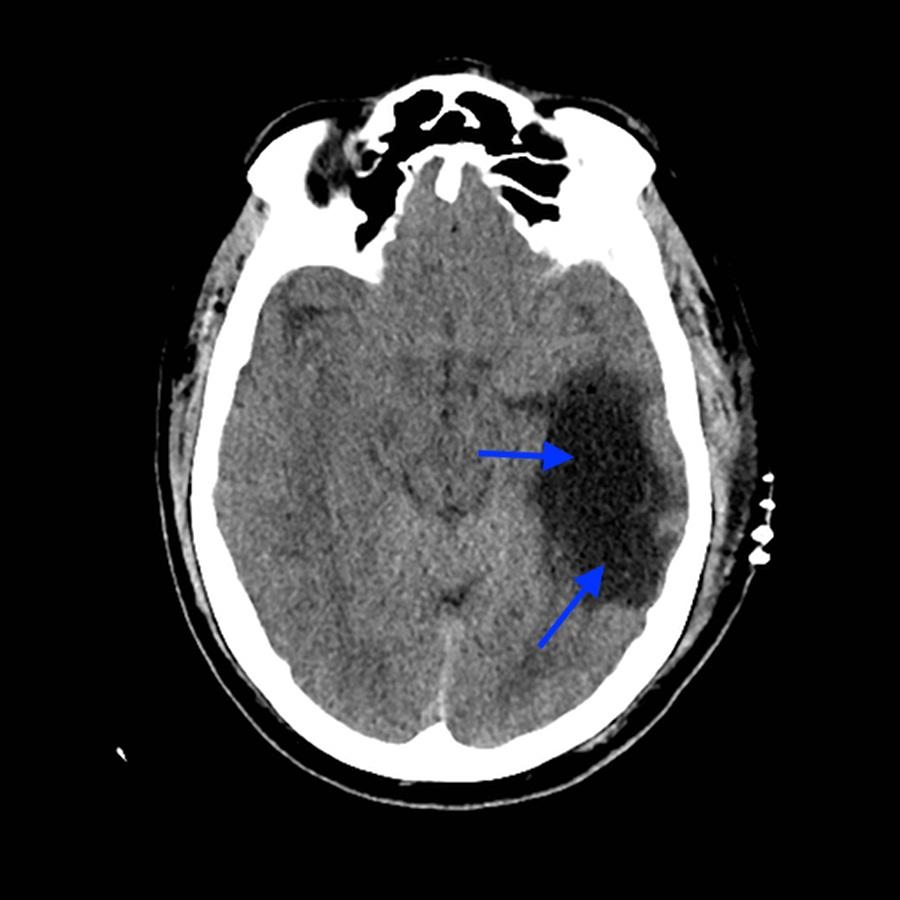 A 49-year-old male was admitted electively for a TL resection of a vestibular schwannoma.