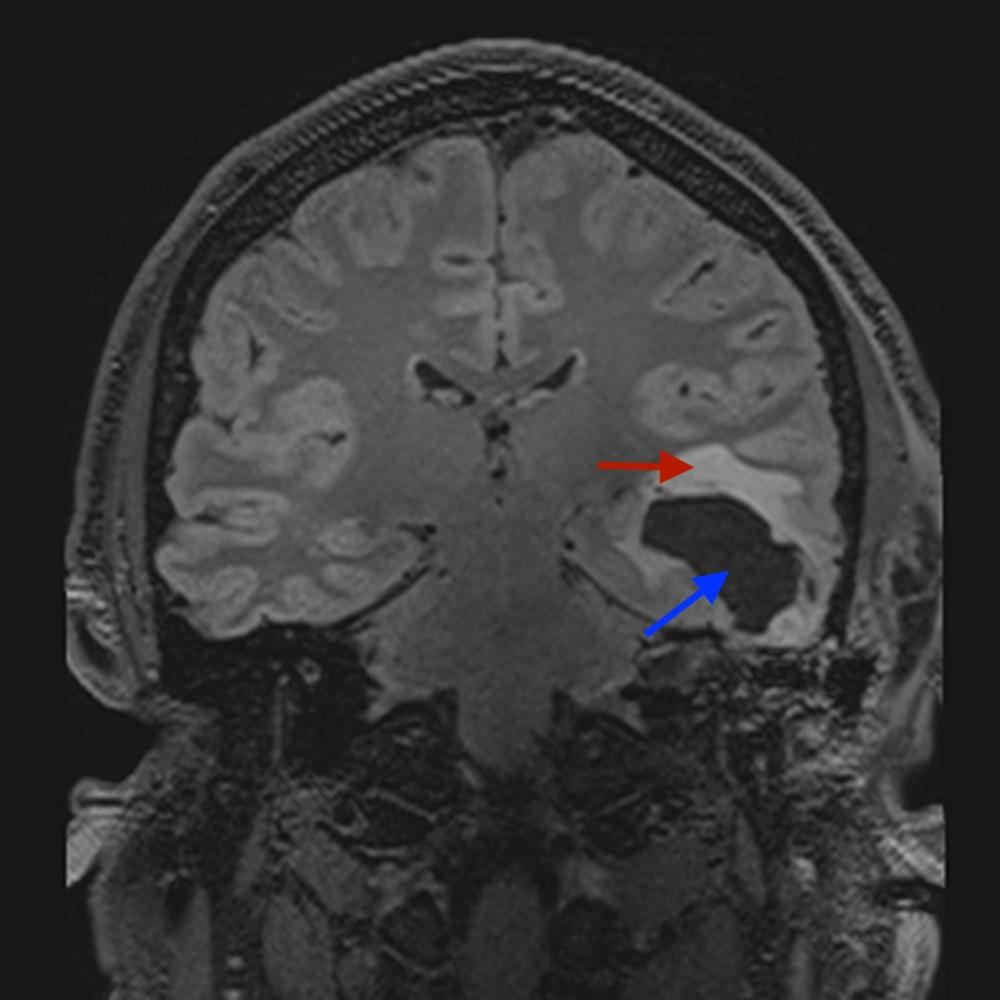 FIGURE 3: Coronal unenhanced T2 fat suppressed MRI of the brain: lucency in the temporal lobe (blue arrow) and associated