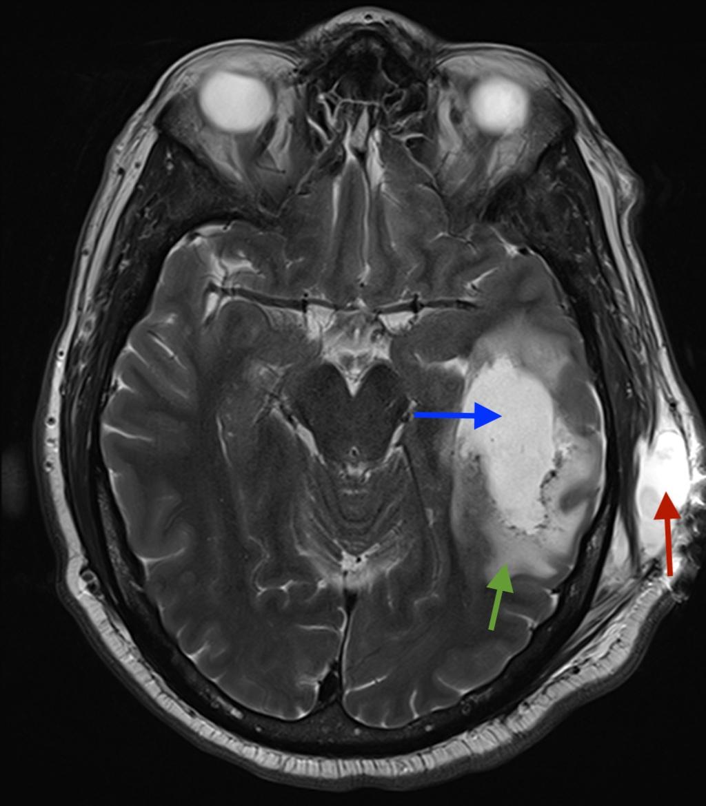 FIGURE 4: Axial unenhanced T2 MRI of the brain: lucency in temporal lobe (blue arrow) and associated surrounding oedema (green arrow), pseudomeningocoele (red arrow) in subcutaneous tissues on the