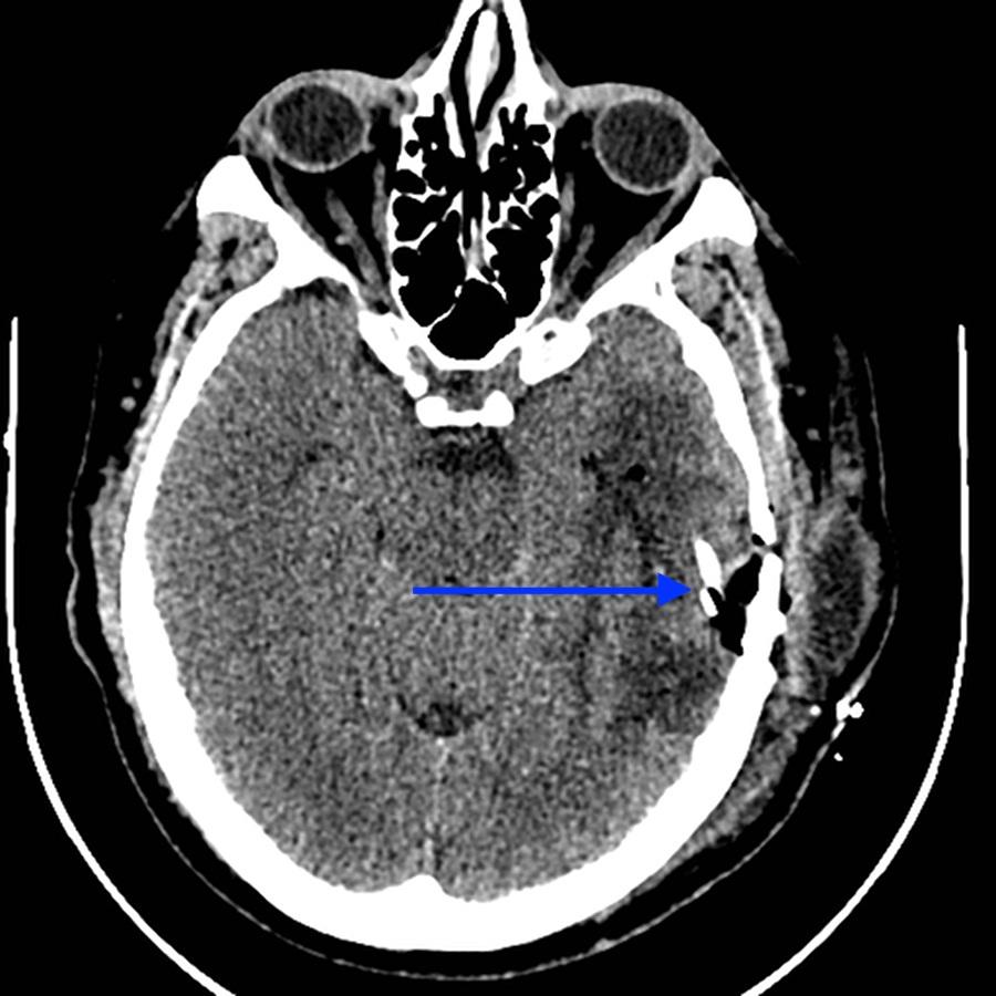 FIGURE 7: Postoperative unenhanced axial CT of the head: end of shunt tube (blue arrow) in subdural space.