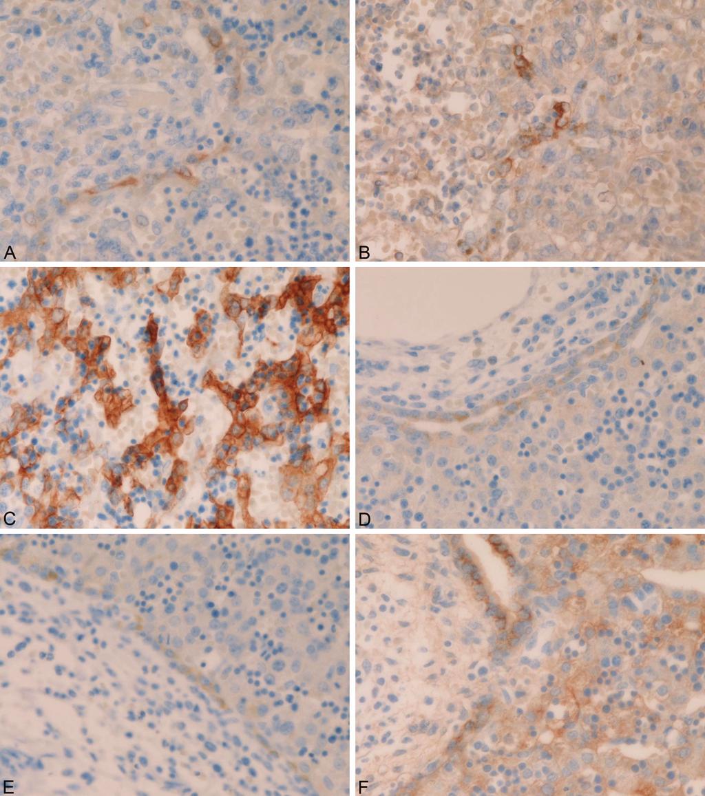 Figure 3. Immunohistochemical findings of cytokeratins. The DP-like structures within the hepatoblasts were positive for biliary-type CK7 (A) and CK19 (B).