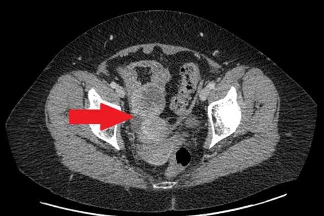 Figure 4. Cross sectional CT scanning demonstrating an abnormality in the pelvis, thought to be dilated terminal ileum with mucosal thickening and hyper-enhancement (red arrow).