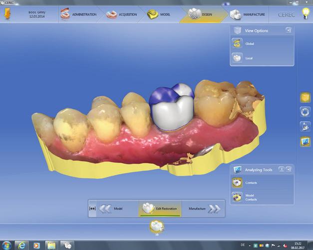 Based on the intraoral scan, the software generates a patient-specific restoration proposal taking into account the existing dental morphology.