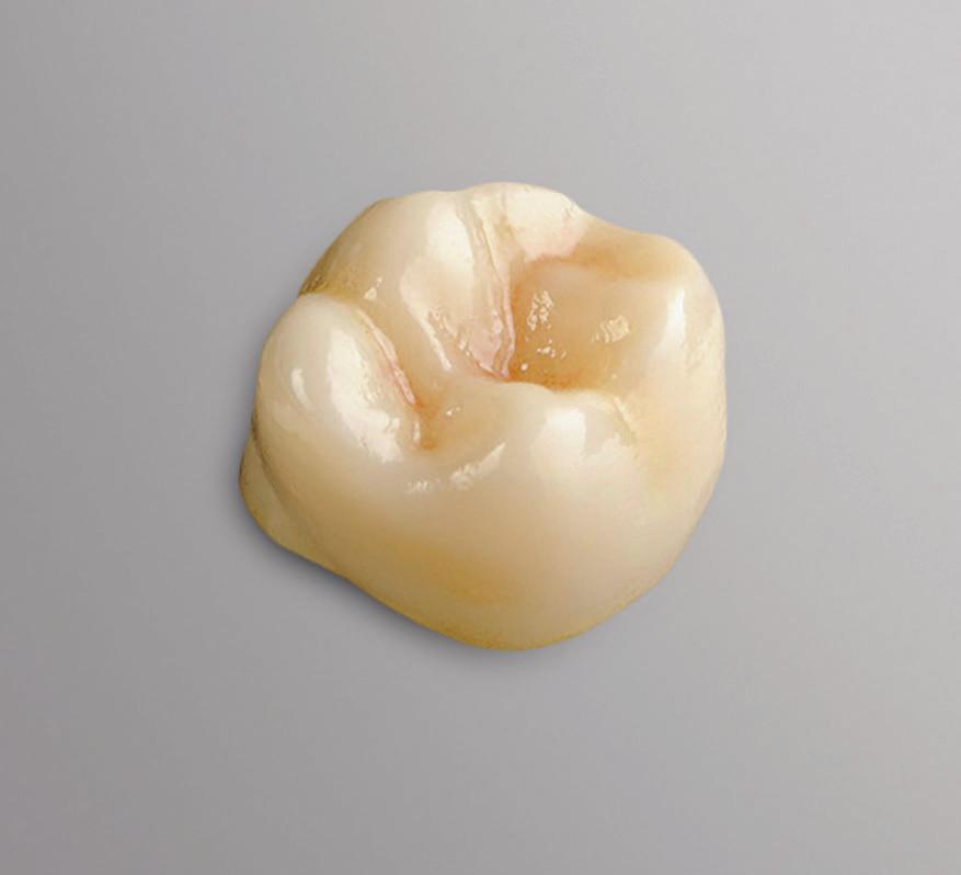 Chairside implants with custom abutments or screwretained crowns with your choice of CEREC blocks in one visit.