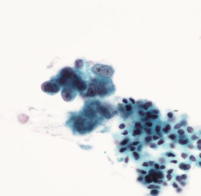 Biopsy/Cytology Terminology ADENOCARCINOMA (Predominant pattern) Acinar Papillary Solid Micropapillary