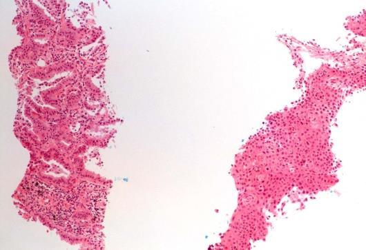 cell carcinoma Non-small cell carcinoma with neuroendocrine (NE) morphology and positive NE markers, possible LCNEC ADENOSQUAMOUS CARCINOMA No counterpart in 2015 WHO