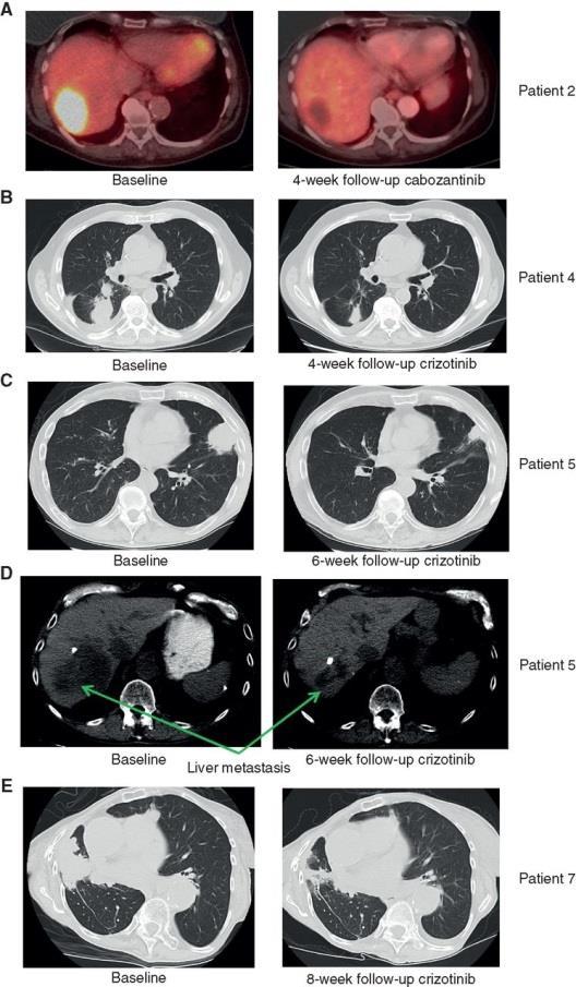 carcinomas of the lung: Comparison of sarcomatous and carcinomatous areas. Kim S et al. Eur J Cancer.