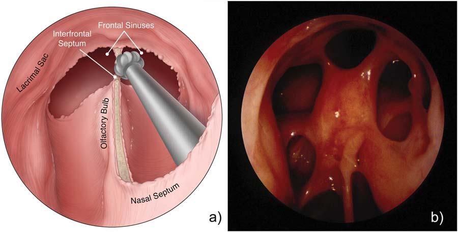 Fig. 1. a). Endoscopic view of frontal sinus drillout procedure as seen from the right nasal cavity.