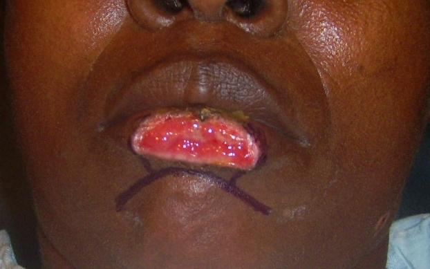 Patient with upper lip loss.