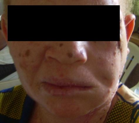 The cheek defects following excision of these lesions were more often zone 2 defects, extending up to the temporal region.