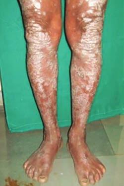 Sanjay G Thete et al Fig. 2: Psoriasis leg Fig. 3: Reticular LP Lichen Planus Lichen planus is one of the most common dermatological diseases that manifest itself in the oral cavity.