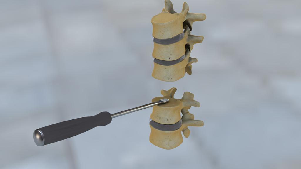 2 Step 3 Bone Grafting Before insertion, load the implant with autograft or allograft (Fig. 3).