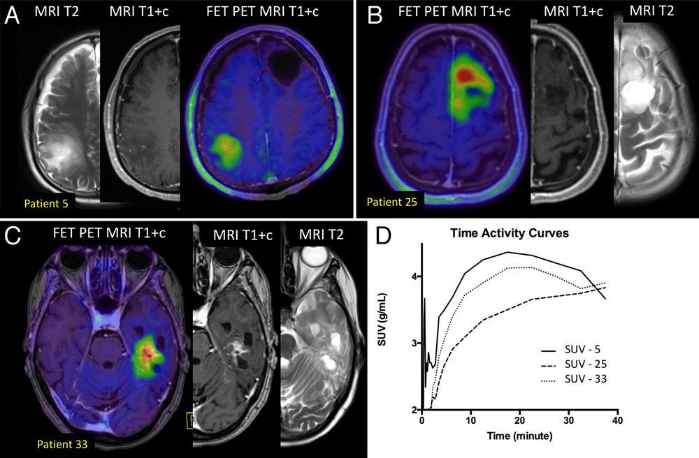 A. Bashir et al. FIG. 2. Patient examples showing static FET20 40 PET images fused to T1-weighted postcontrast (T1+c) and T2-weighted MR images. A: Patient 5.