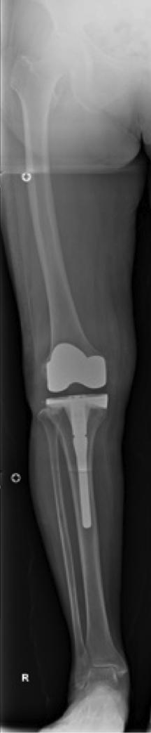 Introduction Total knee arthroplasty (TKA) alters the alignment of whole lower extremity.
