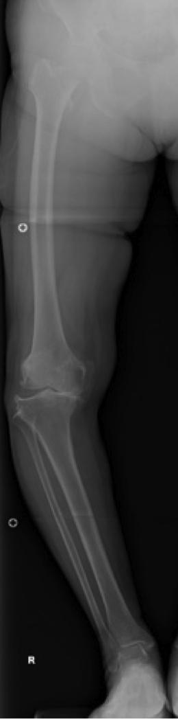 Some authors have reported hindfoot malalignment associated with knee deformity, but what
