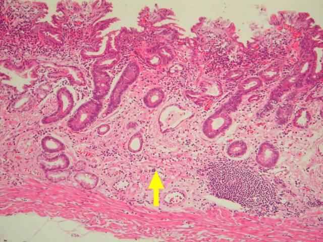 134 Histopathological Characteristics of Atrophic Gastritis in Adult Population classification of gastritis, which use a semi-quantitative estimation and tables to show the type Fig.