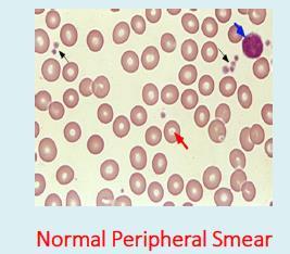 Erythrocyte Abnormalities (Anemia): Deficiency in the oxygen-carrying capacity of the blood due to a