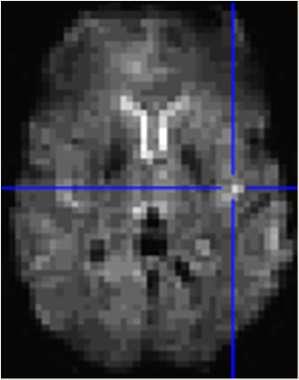 3-Dimensional Data fmri: Detect changes in brain activity somewhere in the brain: 64x64 voxel matrix 43 slices in the brain = 176128 voxels About 1/3 of this area is studied 50,000