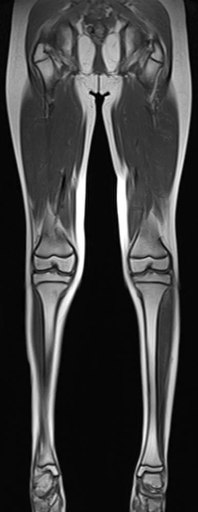 DSN with PRX Mutation B C A D E Fig.. Hip, thigh, and lower calf MRIs of the proband (II-) with PRX mutation.