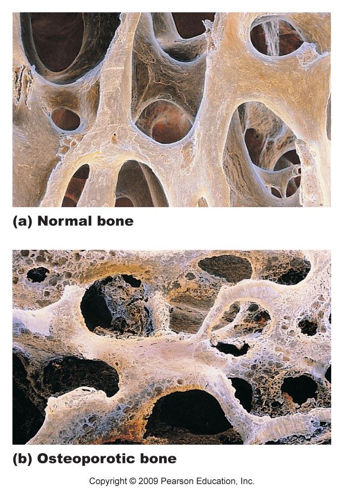HomeostaDc Imbalances Loss of bone mass bone resorpdon outpaces deposit Spongy bone of spine and neck of femur become most suscepdble to fracture Lack of estrogen, calcium or vitamin D; pedte body