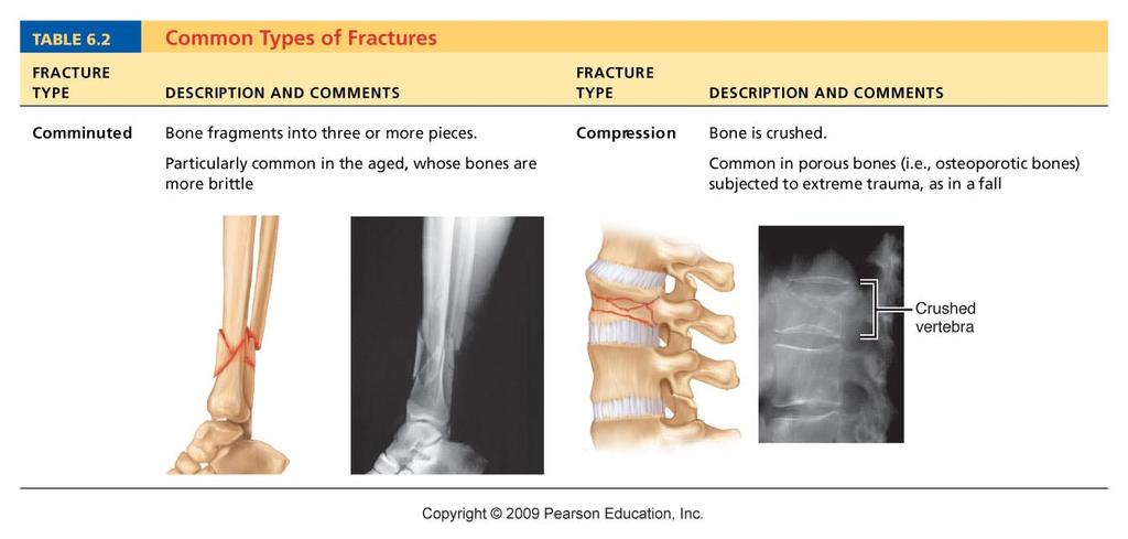 ClassificaDon of Bone Fractures Bone may be classified by four either/or classificadons: 1.
