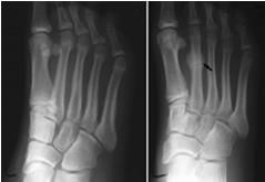 Stress Fractures Slow onset, mild swelling, and tenderness Little soft tissue damage Pain with weight bearing that does not resolve with stretching/exercise (Left) This x-ray of a patient who