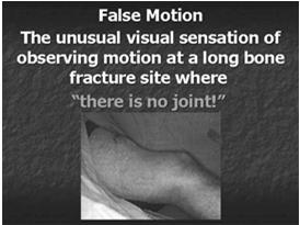 org) Slide 46 Clinical Findings of a Stress Fracture in the Foot History of strenuous activity; possible recent increase in activity (ruck marching) Pain on palpation Pain not relieved with