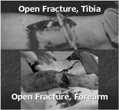 Immediate Referral of Fractures Open fractures Suspected compartment syndrome Nerve, vascular, muscle damage Dislocation: not reduced