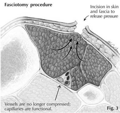 Compartment Syndrome Vicious cycle of: Pressure Vascular occlusion Hypoxia Necrosis