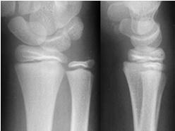 Epiphysis The end of the bone, forming part of the adjacent joint Growth disturbance if injured Salter