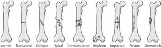 Definition of a Fracture Partial or complete disruption in the continuity of a bone Slide 19 Describing Fractures Anatomic location Direction of fracture line Stability Associated soft tissue injury