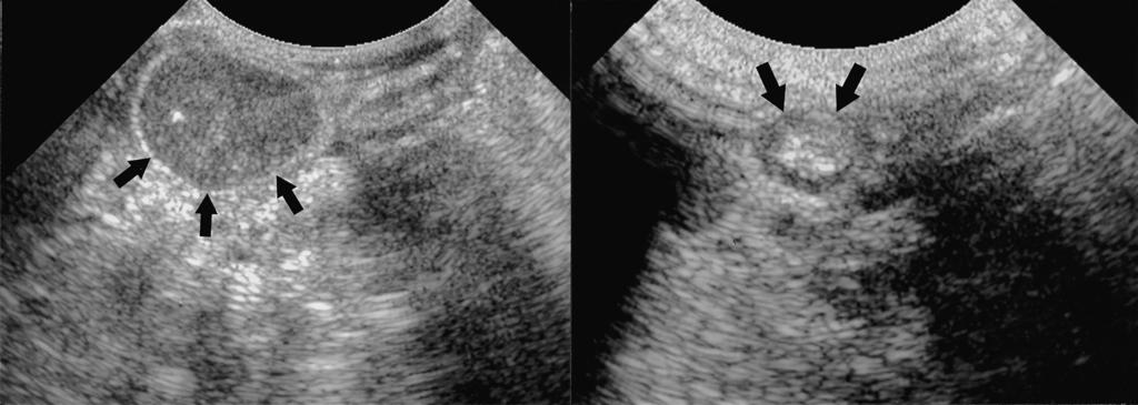 Hyun Woo Goo, et al : Sonography-guided Gastrografin Enema for Meconium Plug Syndrome in Premature Newborns ing from the day on which the meconium plug was evacuated until the gaseous distension of