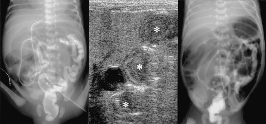 Hyun Woo Goo, et al : Sonography-guided Gastrografin Enema for Meconium Plug Syndrome in Premature Newborns significantly correlated with delay in radiographic improvement, but not with delay in oral
