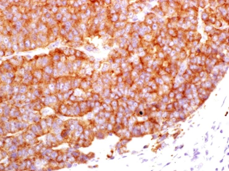 (C) carcinosarcoma with vimentinpositive cells (vimentin immunohistochemical stain, 400); (D) carcinosarcoma with CK-positive cells (CK immunohistochemical stain, 400).